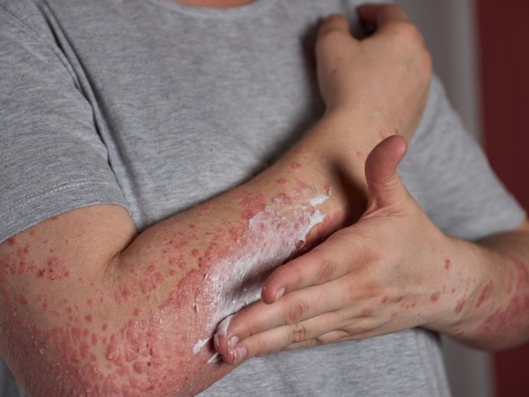 Emollient being applied to dry, inflamed skin
