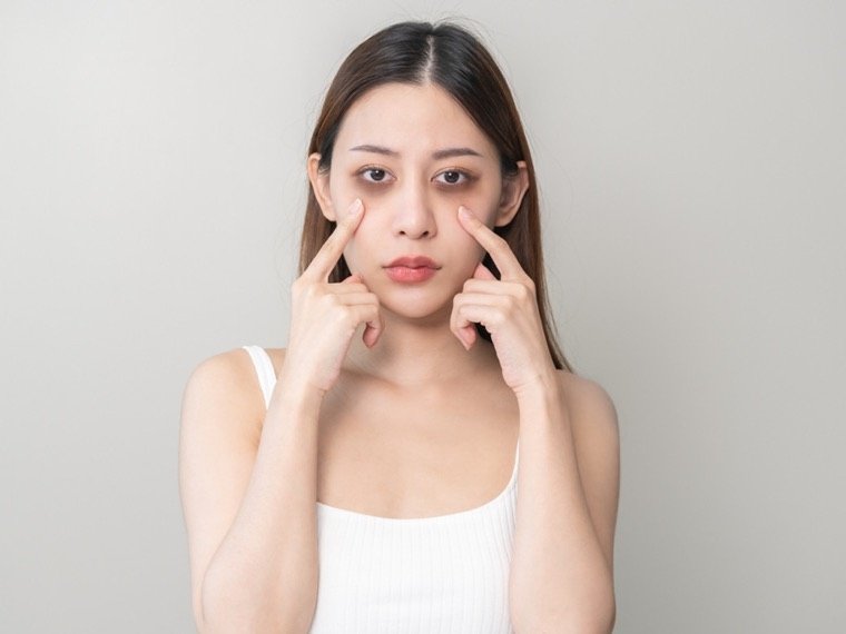 Dark circles under the eyes