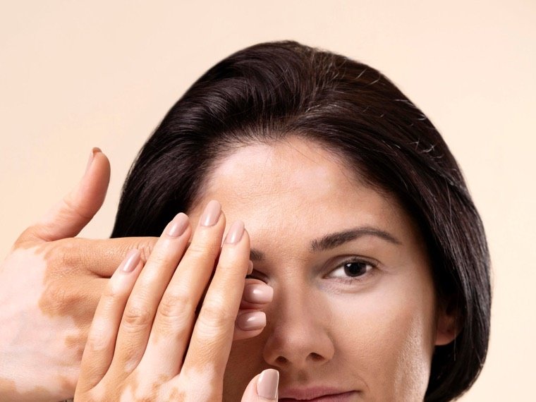 Depigmented patches of vitiligo on the hand and face
